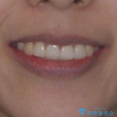 急速拡大装置 狭い歯列を拡大してワイヤー装置で短期間治療の治療後(顔貌)