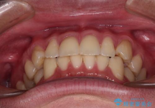 上下のデコボコを治したい インビザラインによる矯正治療の治療前