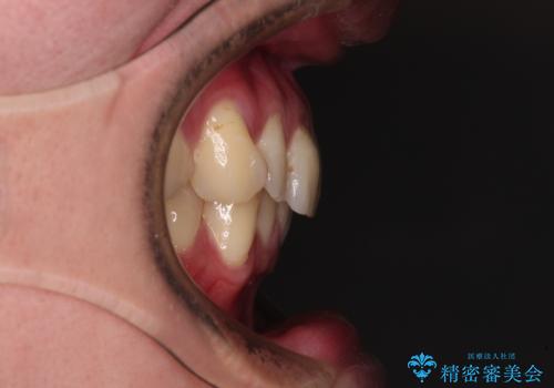 上下のデコボコを治したい インビザラインによる矯正治療の治療前