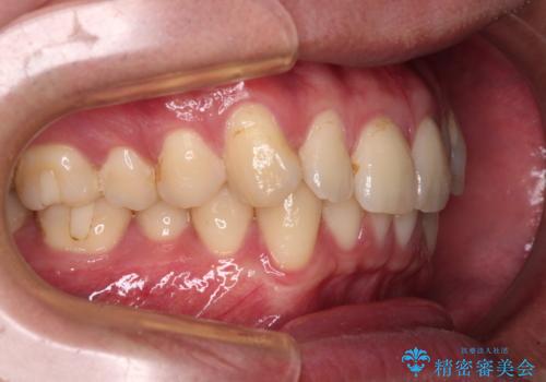 上下のデコボコを治したい インビザラインによる矯正治療の治療前