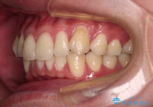 上下のデコボコを治したい インビザラインによる矯正治療の治療前