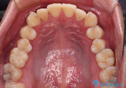上下のデコボコを治したい インビザラインによる矯正治療の治療前