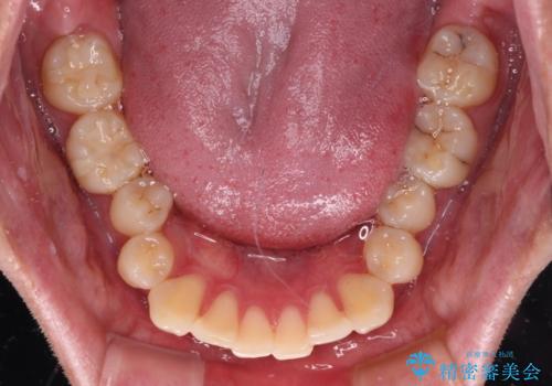 上下のデコボコを治したい インビザラインによる矯正治療の治療前