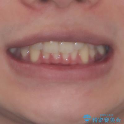 上下のデコボコを治したい インビザラインによる矯正治療の治療前(顔貌)