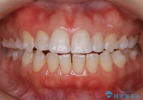 【非抜歯】上下の前歯が噛み合わないオープンバイトの治療の治療中