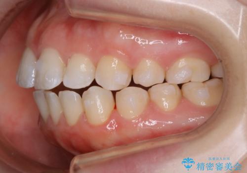 【非抜歯】上下の前歯が噛み合わないオープンバイトの治療の治療中