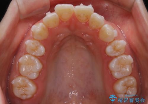【非抜歯】前歯の上下が噛み合わないオープンバイトの治療の治療中