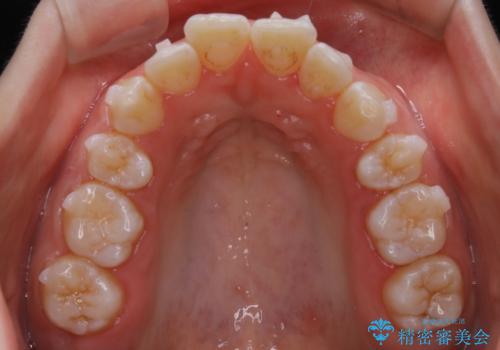 【非抜歯】上下の前歯が噛み合わないオープンバイトの治療の治療中
