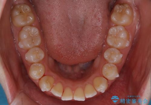 【非抜歯】上下の前歯が噛み合わないオープンバイトの治療の治療中