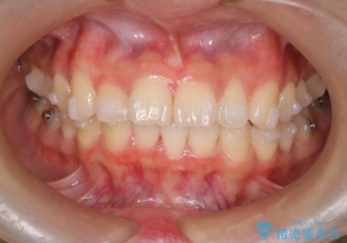 【インビザライン】前歯を下げたい。の治療中