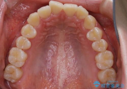 【非抜歯】インビザラインで正しい噛み合わせをの治療前