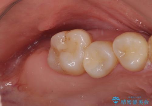 放置したむし歯　抜歯後にインプラントで補綴治療の治療前