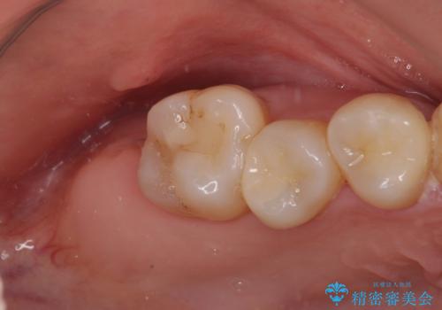 放置したむし歯 抜歯後にインプラントで補綴治療の治療前