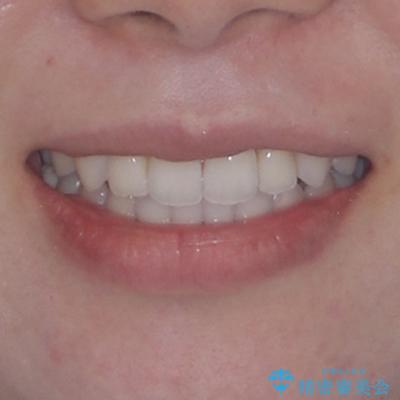 ワーキングホリデー前にきれいな歯列にの治療後(顔貌)