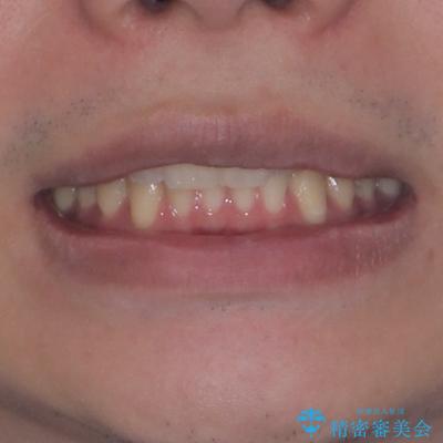 上下のデコボコを治したい インビザラインによる矯正治療の治療後(顔貌)