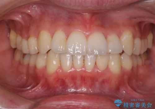 下の前歯が欠けている セラミックで審美的に エアフローで着色除去もの治療後