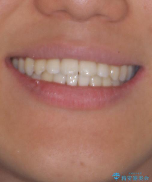 急速拡大装置 歯列弓を拡大して非抜歯ワイヤー矯正の治療後(顔貌)