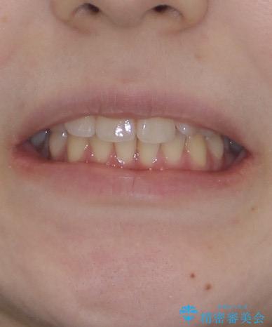 左上の前歯が出ているのが気になる 審美装置による非抜歯ワイヤー矯正の治療前(顔貌)