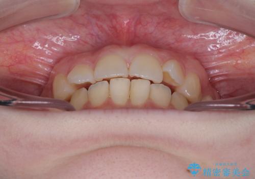 左上の前歯が出ているのが気になる 審美装置による非抜歯ワイヤー矯正の治療前