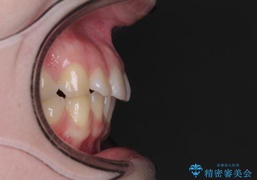 左上の前歯が出ているのが気になる 審美装置による非抜歯ワイヤー矯正の治療前