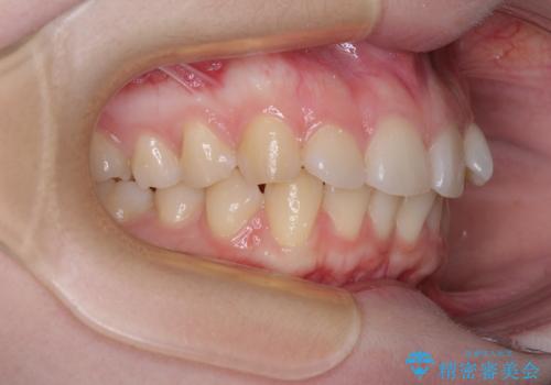 左上の前歯が出ているのが気になる 審美装置による非抜歯ワイヤー矯正の治療前