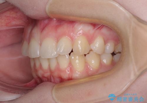 左上の前歯が出ているのが気になる 審美装置による非抜歯ワイヤー矯正の治療前