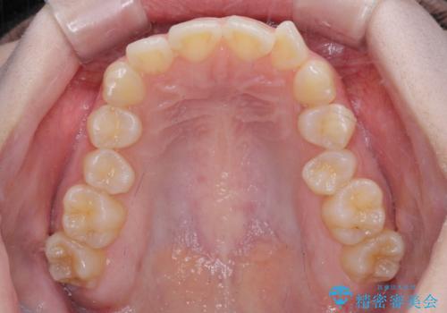 左上の前歯が出ているのが気になる　審美装置による非抜歯ワイヤー矯正の治療前