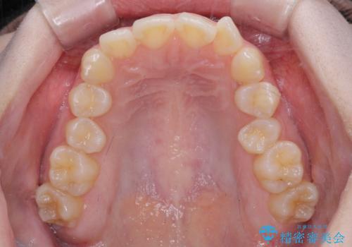左上の前歯が出ているのが気になる 審美装置による非抜歯ワイヤー矯正の治療前