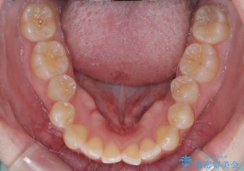 左上の前歯が出ているのが気になる 審美装置による非抜歯ワイヤー矯正の治療前