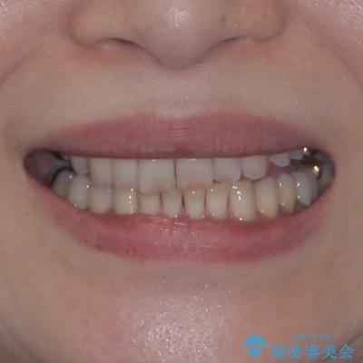 デコボコの歯とむし歯 インビザライン矯正治療とむし歯治療の治療後(顔貌)