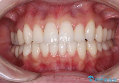 ワーキングホリデー前にきれいな歯列にの症例 治療後