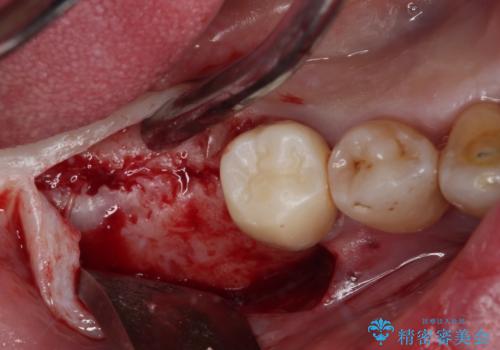 治療中で放置 インプラントでしっかりと咬めるようにの治療前