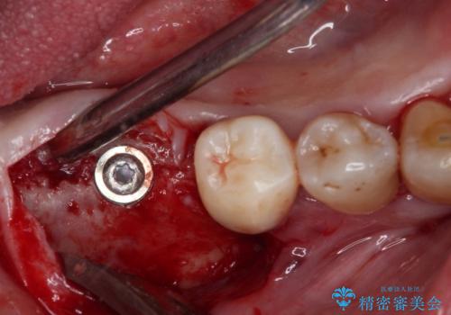 治療中で放置 インプラントでしっかりと咬めるようにの治療中