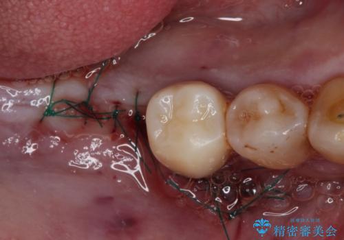治療中で放置　インプラントでしっかりと咬めるようにの治療後