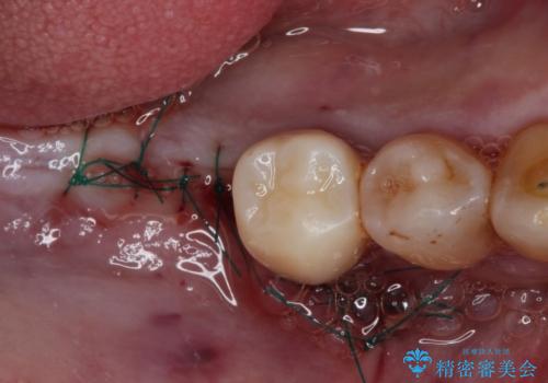 治療中で放置 インプラントでしっかりと咬めるようにの治療後
