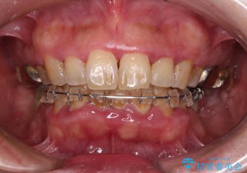 治療中で放置 インプラントでしっかりと咬めるようにの治療前