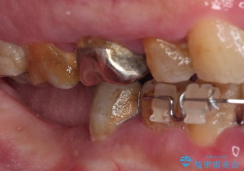 治療中で放置 インプラントでしっかりと咬めるようにの治療前
