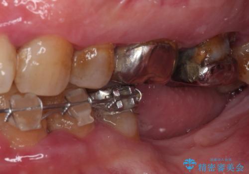 治療中で放置 インプラントでしっかりと咬めるようにの治療前