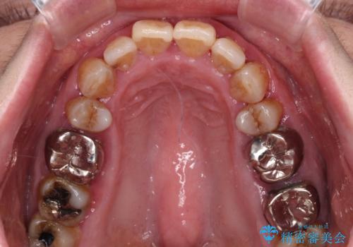 治療中で放置 インプラントでしっかりと咬めるようにの治療前
