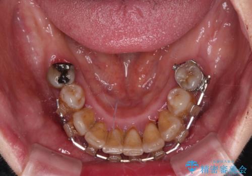 治療中で放置 インプラントでしっかりと咬めるようにの治療前