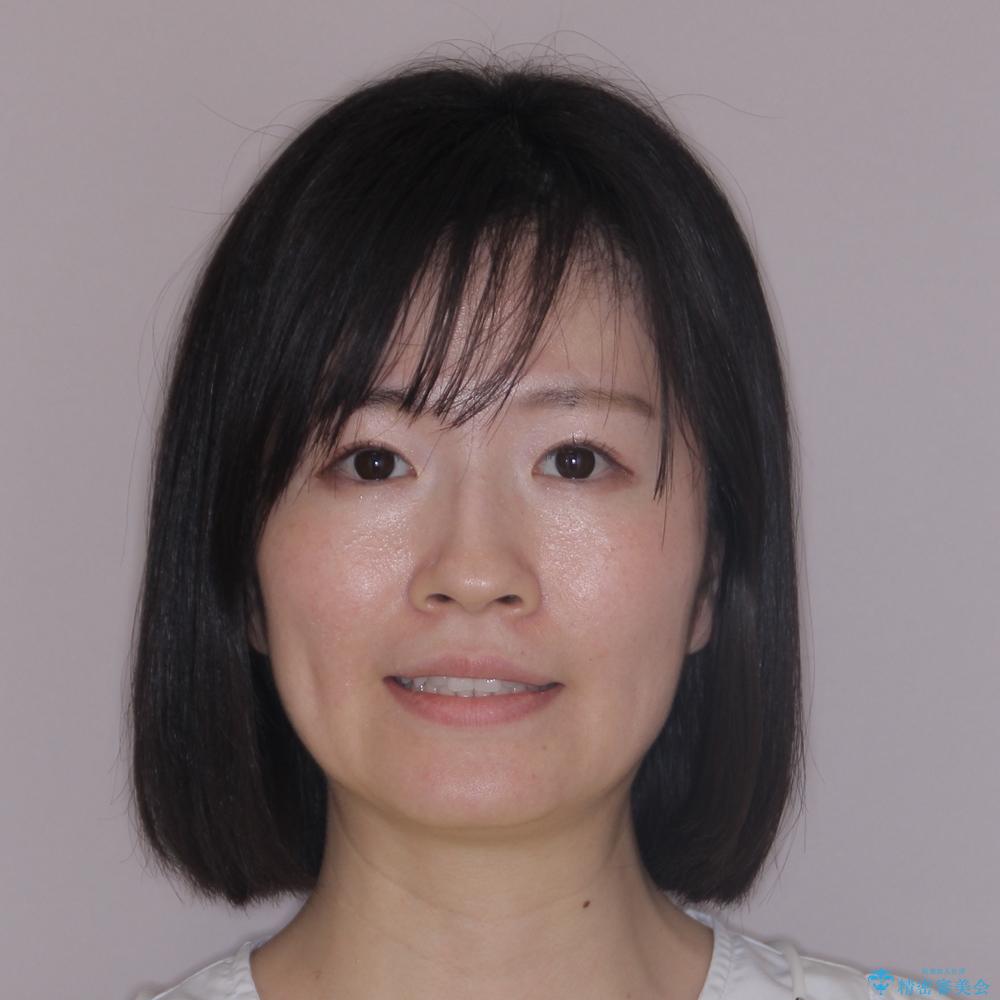 【モニター】インビザラインで気になるデコボコと八重歯をきれいに整えるの治療後(顔貌)