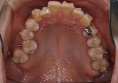 前歯が内側に入っている:インビザライン治療の治療中