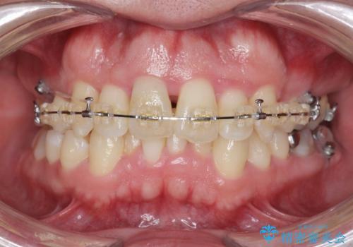 [突き出た前歯を引っ込めたい] ワイヤー矯正とマウスピース矯正の併用治療の治療中