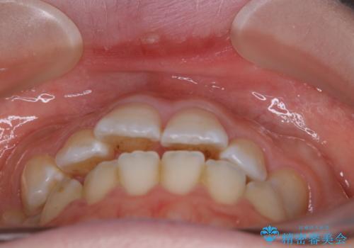 【非抜歯】上下の前歯が噛み合わないオープンバイトの治療の治療前