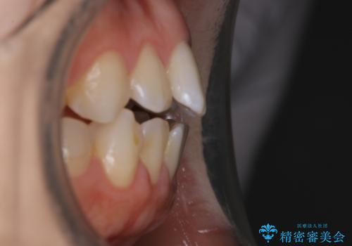 【非抜歯】上下の前歯が噛み合わないオープンバイトの治療の治療前