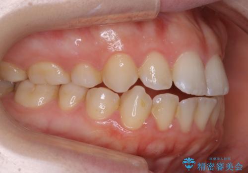 【非抜歯】上下の前歯が噛み合わないオープンバイトの治療の治療前