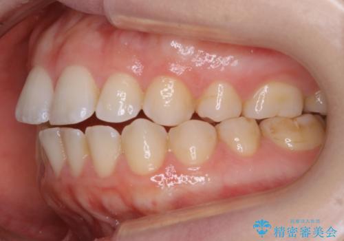 【非抜歯】上下の前歯が噛み合わないオープンバイトの治療の治療前