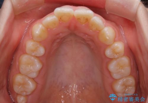 【非抜歯】前歯の上下が噛み合わないオープンバイトの治療の治療前