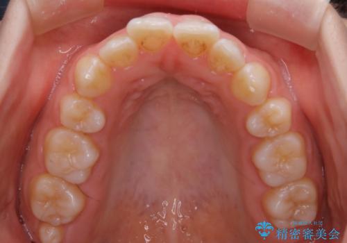 【非抜歯】上下の前歯が噛み合わないオープンバイトの治療の治療前