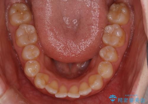 【非抜歯】前歯の上下が噛み合わないオープンバイトの治療の治療前